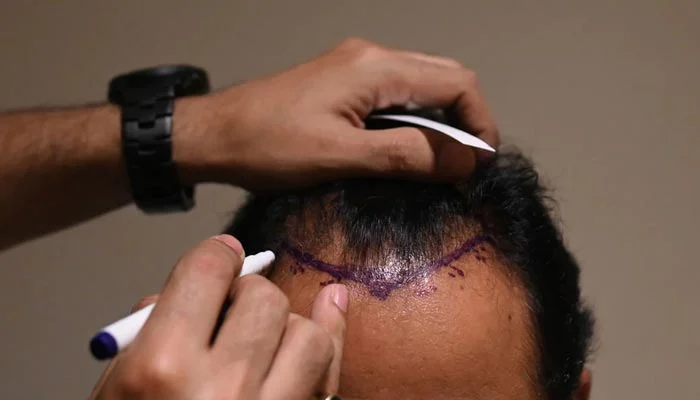 Haarausfall Nürnberg: Die besten Haartransplantationskliniken in Nürnberg