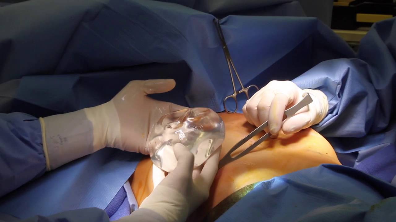 Brustvergrößerung mit Straffung: Implantate vs. Eigenfetttransplantation