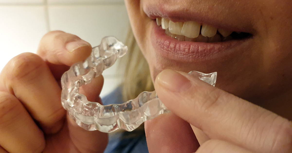 Die Zukunft der Kieferorthopädie: Fortschritte in der Technologie transparenter Aligner
